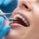 Лікування карієсу та художня реставрація зубів: методи повернення здоров’я та краси посмішки